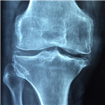 Ultrosonografia Calcaneare