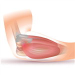 Novità fisioterapia: terapia ad Onde d’Urto